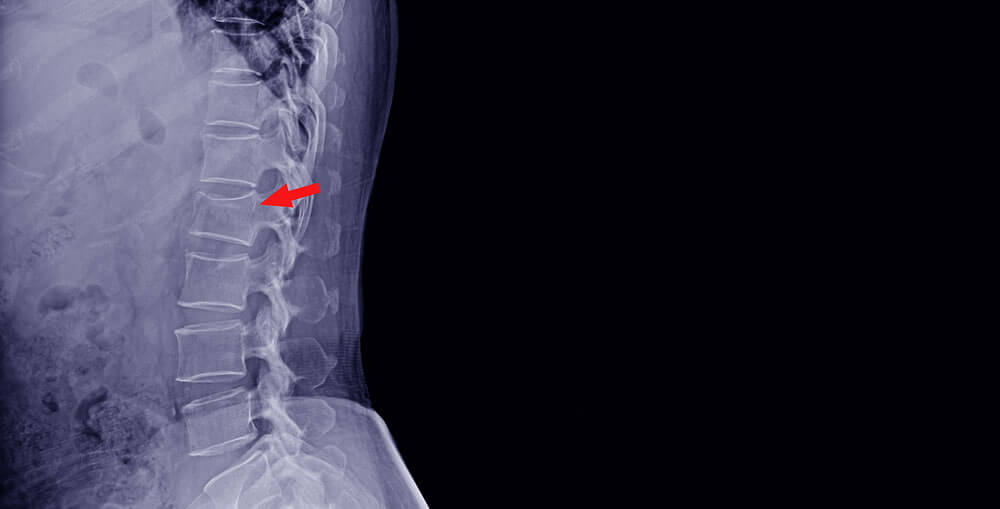 X-Ray Spine - Lateral Views